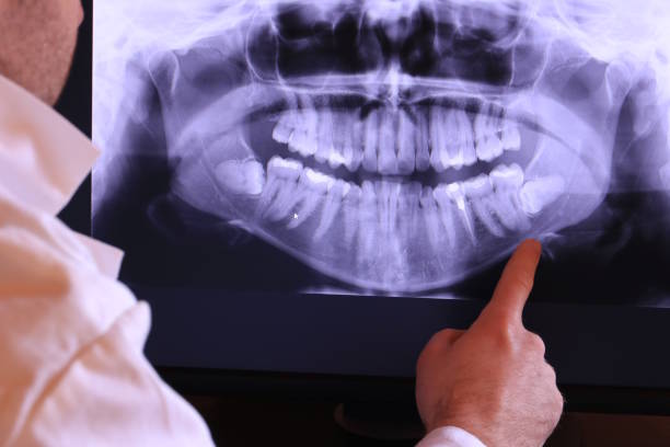 Best Emergency Wisdom Teeth Removal in Morris, AL